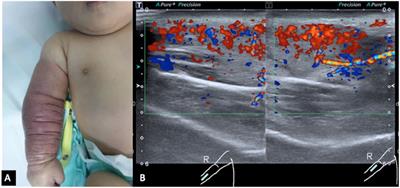 Case report: Kaposi hemangioendothelioma of the right upper limb with the Kasabach–Merritt phenomenon: A potentially lethal diagnostic challenge